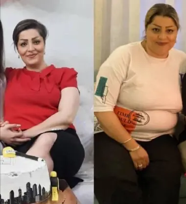 جراحی عکس واقعی چربی شکم