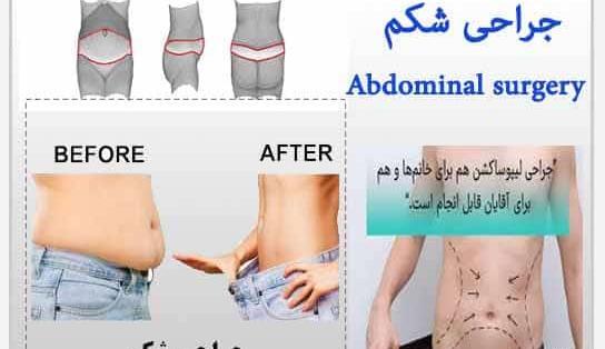 جراحی عکس واقعی چربی شکم
