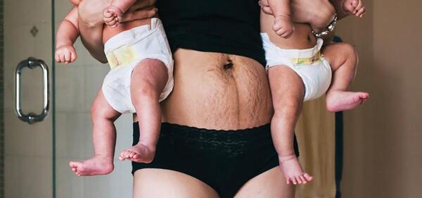 جراحی عکس واقعی چربی شکم