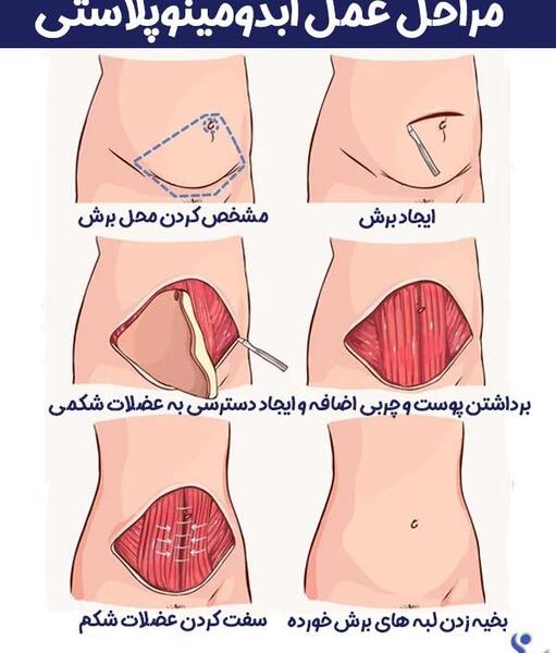 جراحی عکس واقعی چربی شکم