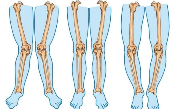 عکس اسکلت چشم ضربدری