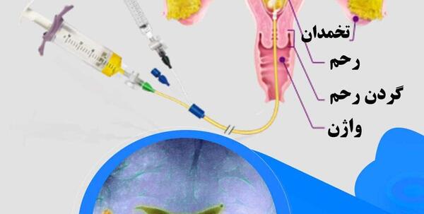 کیا دوبار عکس رنگی رحم گرفتن