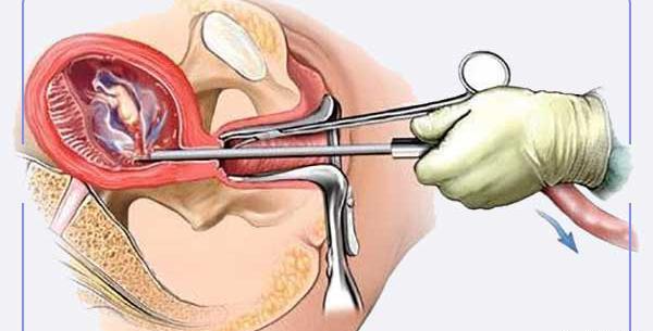 کیا عکس رنگی رحم با بیهوشی گرفتن نی نی سایت