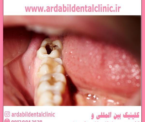 کیا تو بارداری عکس دندون گرفتن