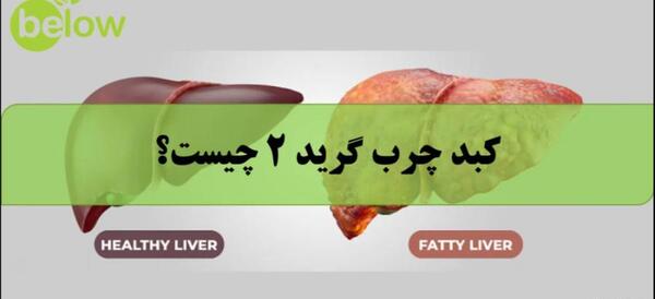 عکس کبد چرب گرید ۱