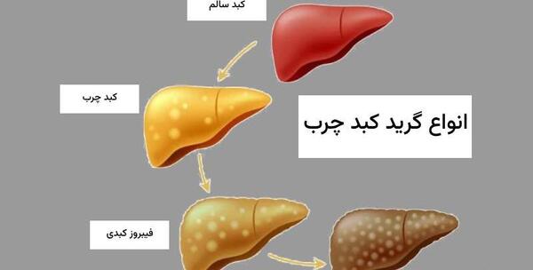 عکس کبد چرب گرید 2