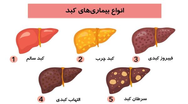 عکس کبد چرب گرید 2