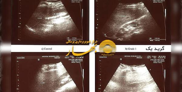 عکس کبد چرب گرید 2