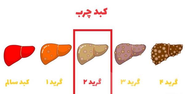 عکس کبد چرب گرید 2