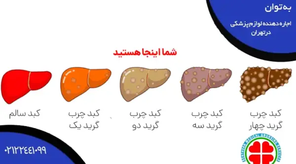 عکس کبد چرب گرید 2