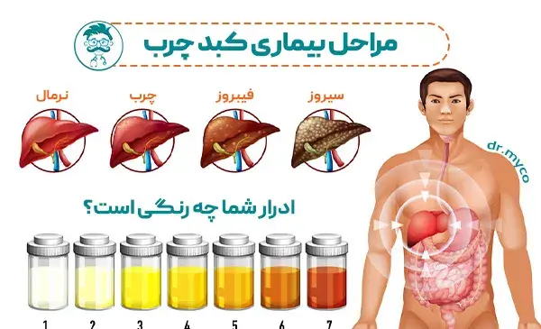 عکس کبد چرب گرید 3