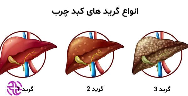عکس کبد چرب گرید 3