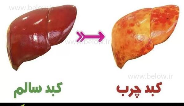 عکس کبد چرب گرید 4