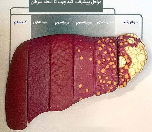 عکس کبد چرب گرید 4