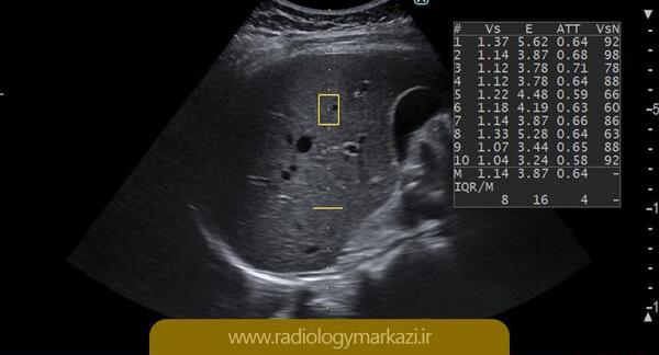 عکس کبد چرب گرید 4