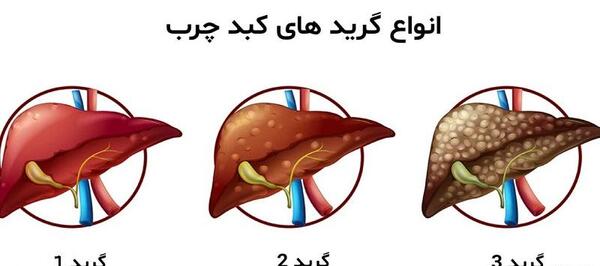 عکس کبد چرب در سونوگرافی
