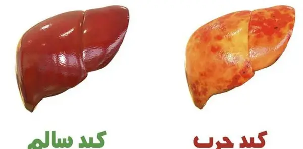 عکس کبد چرب در سونوگرافی