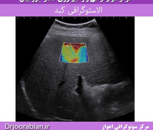 عکس کبد چرب در سونوگرافی