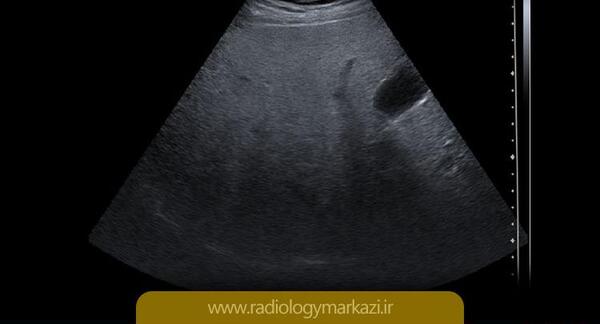 عکس کبد چرب در سونوگرافی