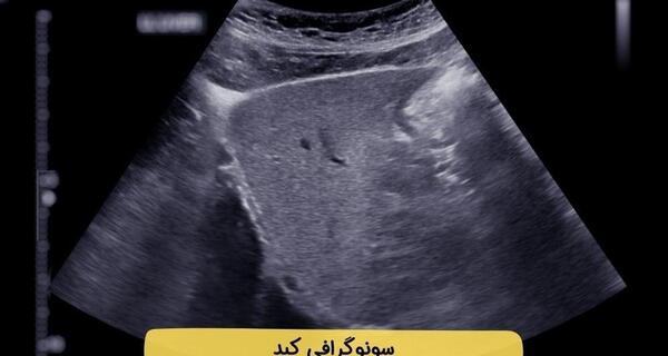 عکس کبد چرب در سونوگرافی