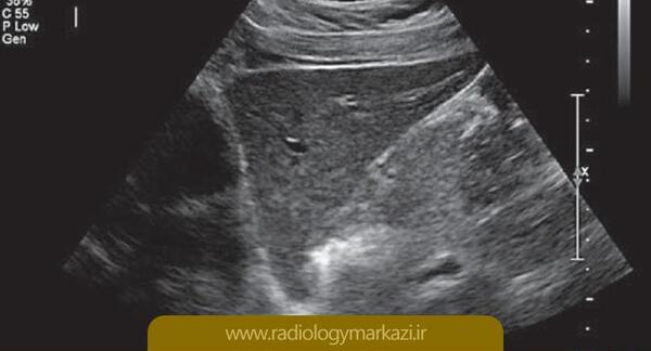 عکس کبد چرب در سونوگرافی