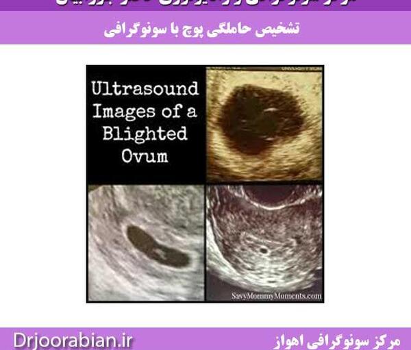 عکس کبد چرب در سونوگرافی