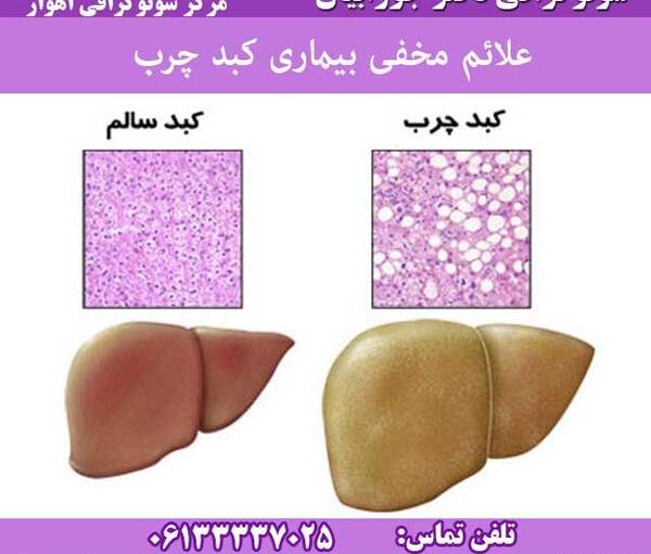 عکس کبد چرب و سالم
