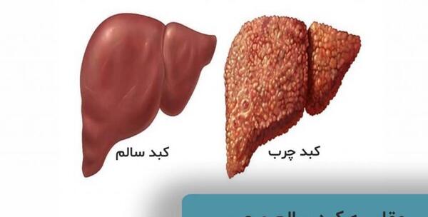 عکس کبد چرب و سالم