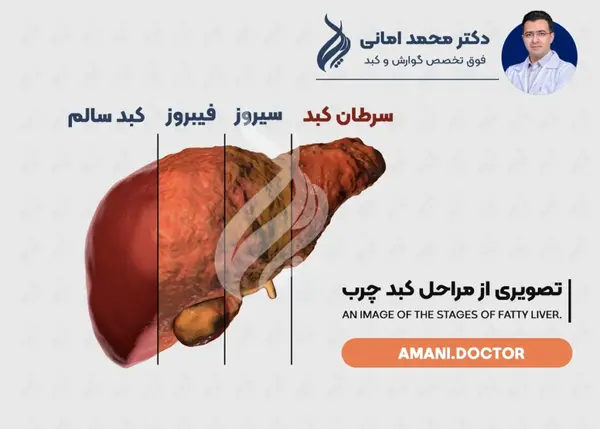 عکس کبد چرب و سالم