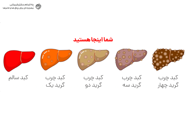 عکس کبد چرب واقعی