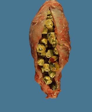 عکس کبد چرب واقعی