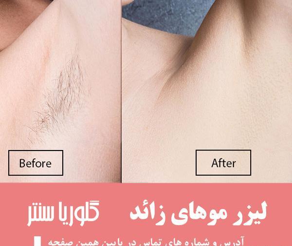 عکس اپیلاسیون ناحیه تناسلی نی نی سایت