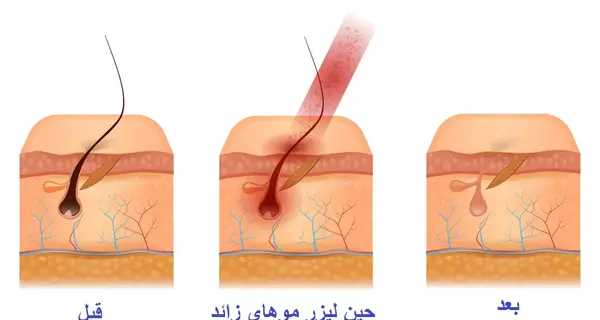 عکس اپیلاسیون ناحیه تناسلی نی نی سایت