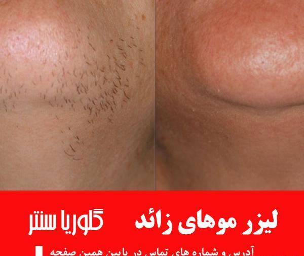 عکس اپیلاسیون ناحیه تناسلی نی نی سایت