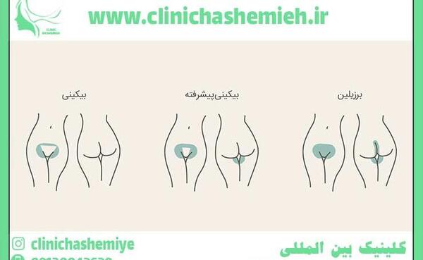 عکس اپیلاسیون بیکینی