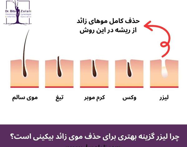 عکس اپیلاسیون بیکینی