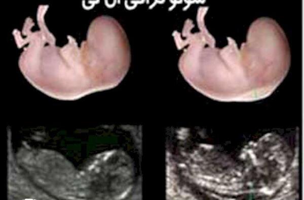 عکس ماه اول جنین