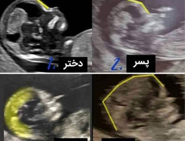 عکس جنین پسر در سونو nt نی نی سایت
