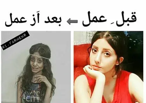 عکس ملیکا تهامی قبل عمل