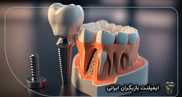 عکس بازیگران ایرانی که دندان مصنوعی دارند