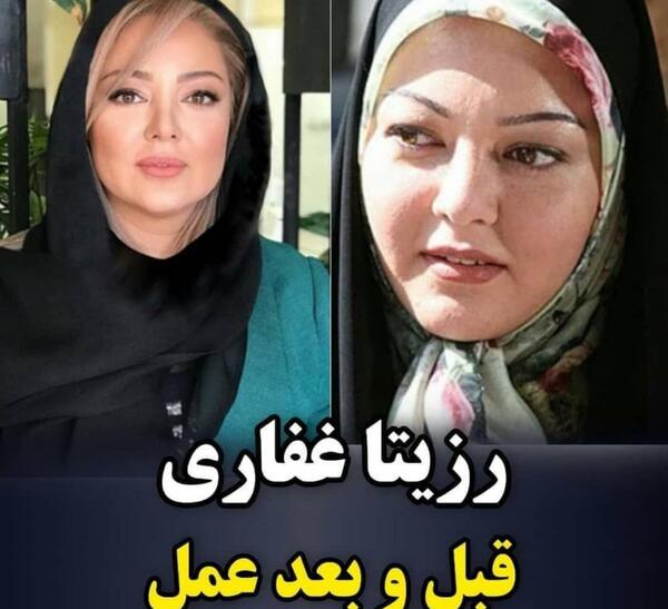 عکس بازیگران ایرانی قبل و بعد از عمل زیبایی