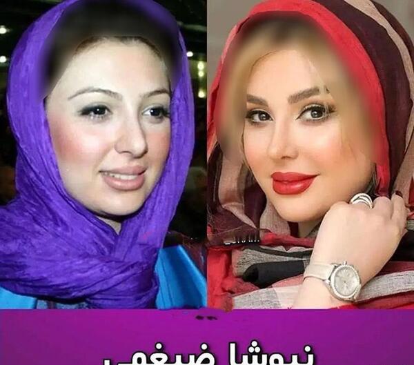 عکس بازیگران مرد ایرانی قبل و بعد از عمل زیبایی