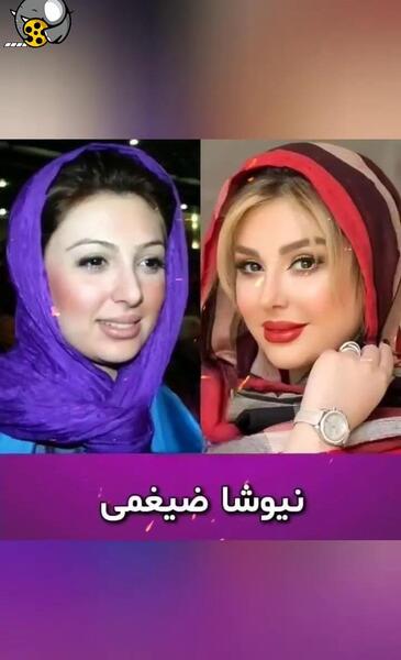 عکس های بازیگران ایرانی قبل و بعد از عمل زیبایی