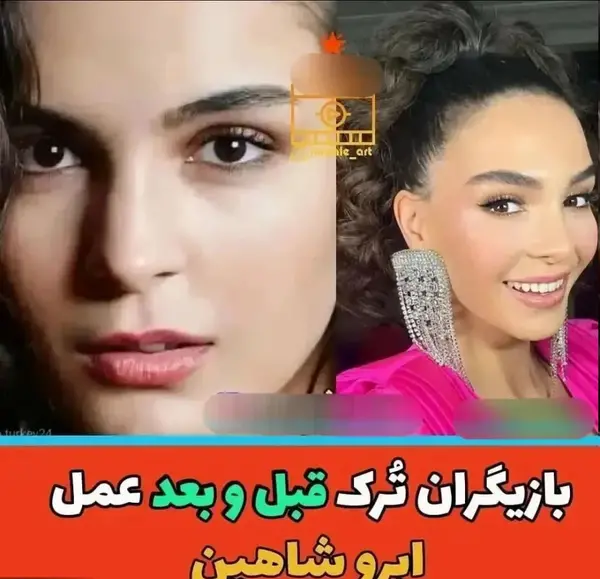 عکس بازیگران ترکی قبل عمل