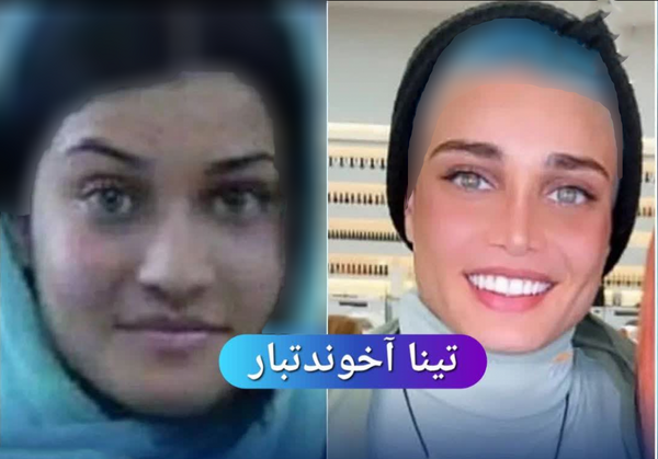 عکس بازیگران قبل و بعد از عمل زیبایی