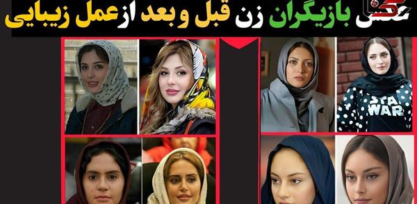 عکس بازیگران قبل و بعد از عمل زیبایی