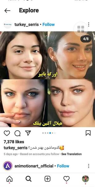 عکس بازیگران ترکی قبل و بعد از عمل