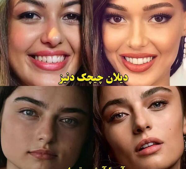 عکس بازیگران ترکی قبل و بعد از عمل