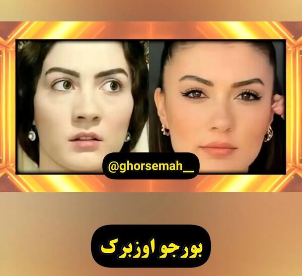 عکس بازیگران ترکی قبل و بعد از عمل
