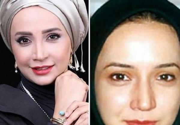 عکس بازیگران زن ایرانی قبل و بعد عمل زیبایی